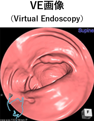 VE画像(Virtual Endoscopy)